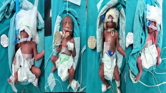 Women's hospital created a record: Mother gave birth to four children through normal delivery
